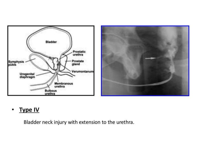 retrograde urethrogram for urology residents | PPTX