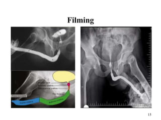 Utricular Cyst Rgu RGU1.pptx positioning of RGU and its procedure | PPTX