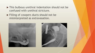 Utricular Cyst Rgu RGU and MCU – Procedure and interpretation in commonly encountered ...