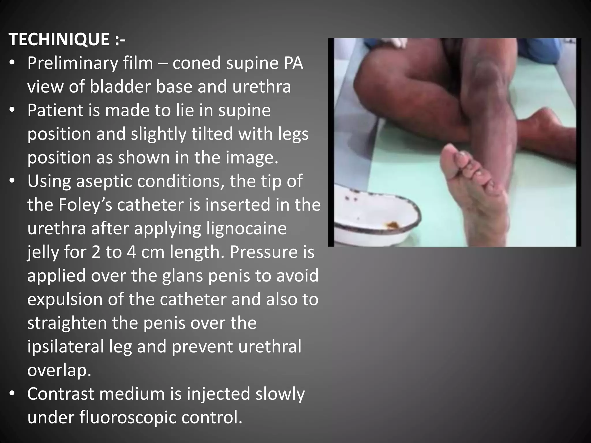 Anterograde/Retrograde urethrography (RGU/MCU) | PPTX