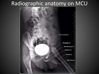 Anterograde/Retrograde urethrography (RGU/MCU) | PPTX