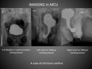 Anterograde/Retrograde urethrography (RGU/MCU) | PPTX
