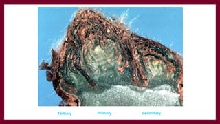 Secondary
Primary
Tertiary
 