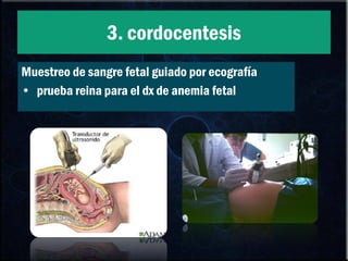 3. cordocentesis Muestreo de sangre fetal guiado por ecografía prueba reina para el dx de anemia fetal 