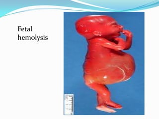 Severe form- Rh
incompatibility
1- Hydrops fetalis (Massive
fetal red blood cell
destruction).
2- It causes Severe
anemia...