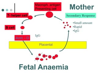 Anti - D
Macroph. antigen
Presenting cell
T- helper cell
B cell
Fetal Anaemia
Mother
Placental
Secondary Response
•Small a...