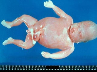 Kernicterus
Concentration of bilirubin in the
newborn blood exceeds
20mg/100ml or
in-term fetus – > 342 mmoll/L
in pre-ter...