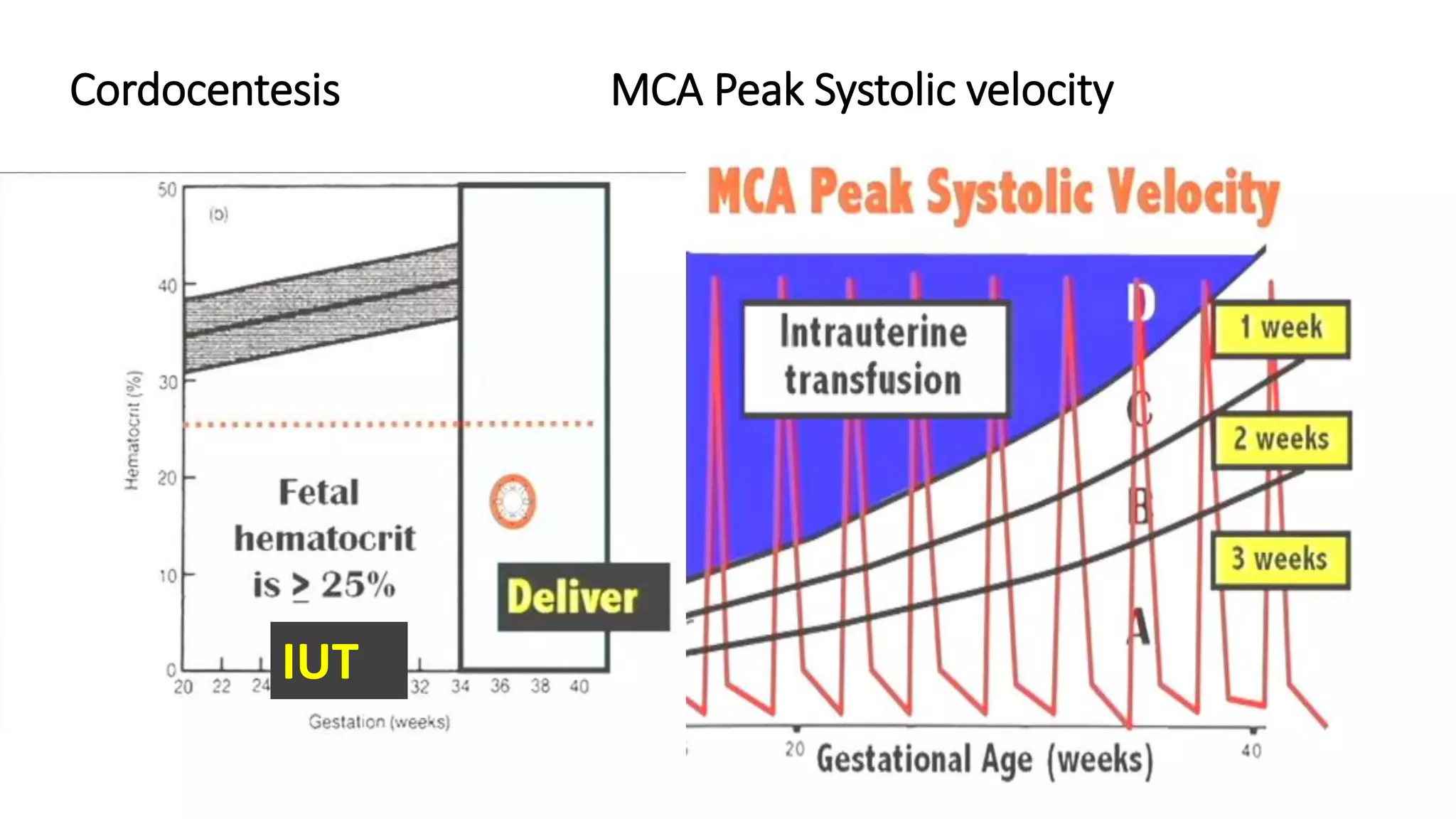 Cordocentesis MCA Peak Systolic velocity
IUT
 