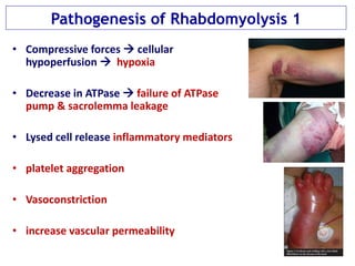 Pathogenesis of Rhabdomyolysis 1
• Compressive forces  cellular
hypoperfusion  hypoxia
• Decrease in ATPase  failure of ATPase
pump & sacrolemma leakage
• Lysed cell release inflammatory mediators
• platelet aggregation
• Vasoconstriction
• increase vascular permeability
 