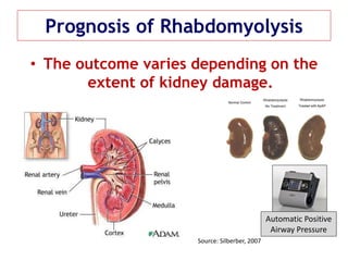 Prognosis of Rhabdomyolysis
• The outcome varies depending on the
extent of kidney damage.
Source: Silberber, 2007
Automatic Positive
Airway Pressure
 