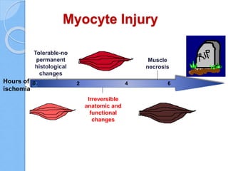 Myocyte Injury
Hours of
ischemia
0 2 4 6
Tolerable-no
permanent
histological
changes
Irreversible
anatomic and
functional
changes
Muscle
necrosis
 
