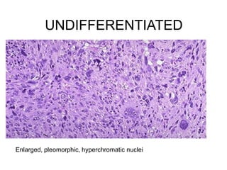Pleomorphic Rms Rhabdomyosarcoma | PPTX