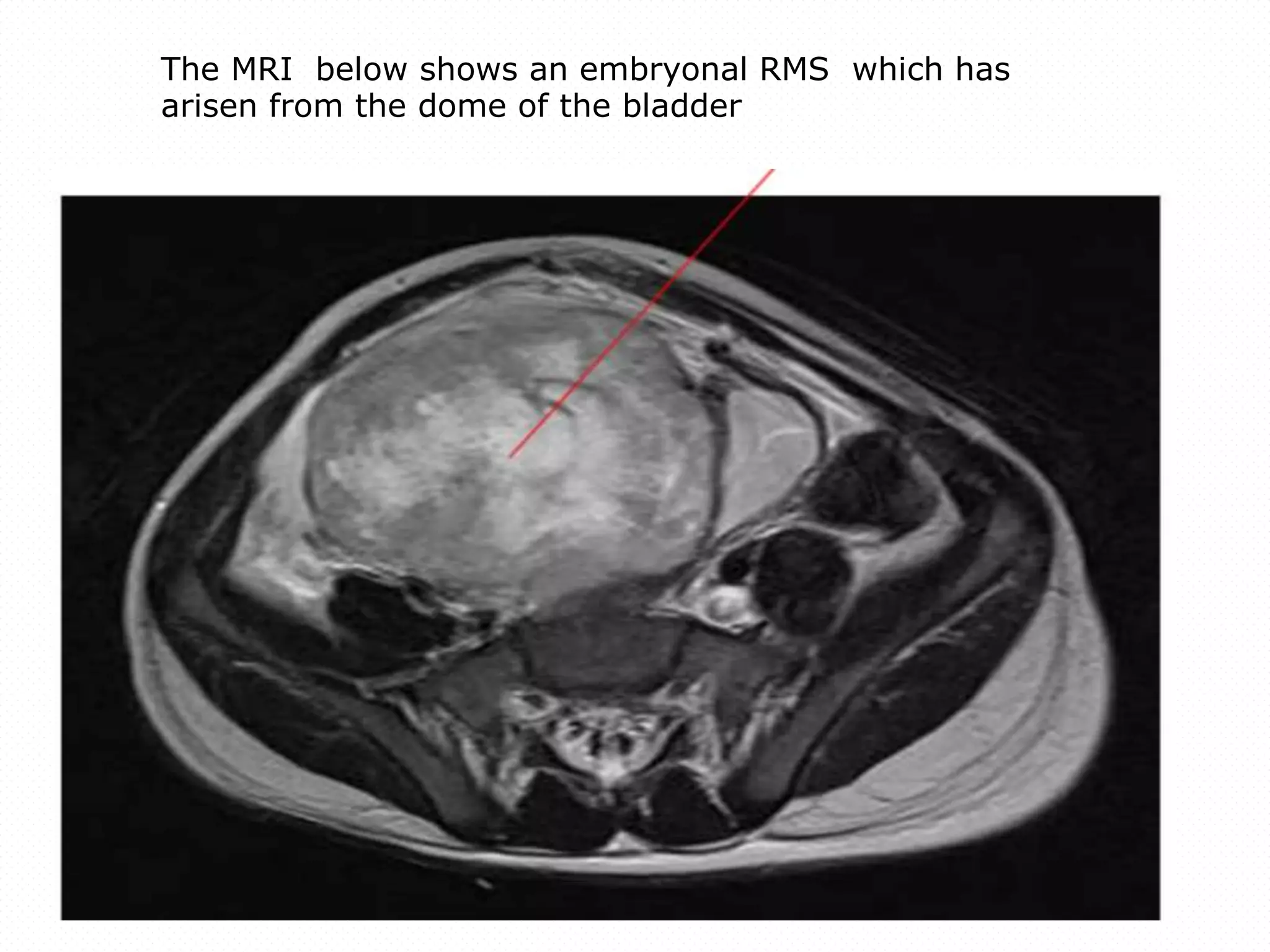 Embryonal Rms Rhabdomyosarcoma | PPTX