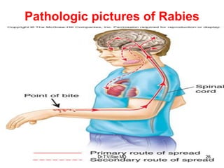 Pathologic pictures of Rabies
26
Dr.T.V.Rao MD 26
 