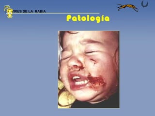 Patología  VIRUS DE LA  RABIA 
