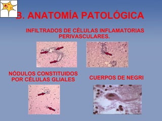 B. ANATOMÍA PATOLÓGICA  CUERPOS DE NEGRI INFILTRADOS DE CÉLULAS INFLAMATORIAS PERIVASCULARES.  NÓDULOS CONSTITUIDOS POR CÉLULAS GLIALES 