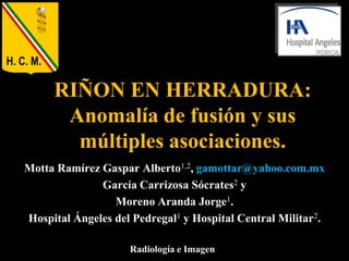 H. C. M.

           RIÑON EN HERRADURA:
            Anomalía de fusión y sus
             múltiples asociaciones.
    Mot...