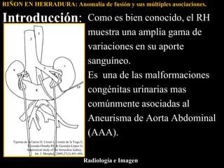 RIÑON EN HERRADURA: Anomalía de fusión y sus múltiples asociaciones.

Introducción:                                       ...