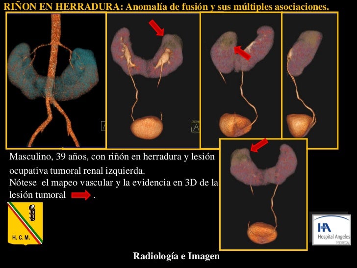RIÑON EN HERRADURA Anomalía de fusión y sus múltiples asociaciones.