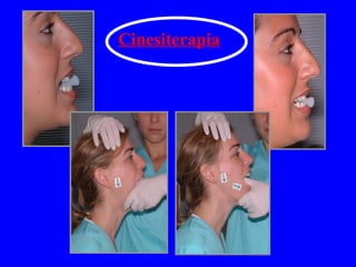 Cinesiterapia 