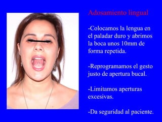 Adosamiento lingual -Colocamos la lengua en el paladar duro y abrimos la boca unos 10mm de forma repetida. -Reprogramamos el gesto justo de apertura bucal. -Limitamos aperturas excesivas. -Da seguridad al paciente. 
