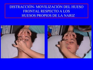DISTRACCIÓN- MOVILIZACIÓN DEL HUESO FRONTAL RESPECTO A LOS HUESOS PROPIOS DE LA NARIZ 