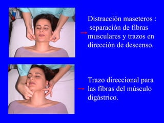 Distracción maseteros : separación de fibras musculares y trazos en dirección de descenso. Trazo direccional para las fibras del músculo digástrico. 
