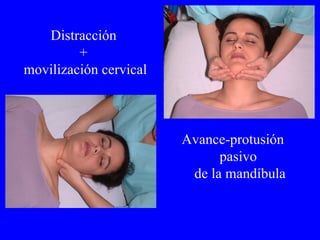 Distracción  +  movilización cervical Avance-protusión  pasivo  de la mandíbula 