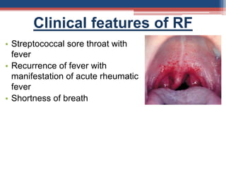 Clinical features of RF
• Streptococcal sore throat with
fever
• Recurrence of fever with
manifestation of acute rheumatic
fever
• Shortness of breath
 