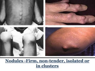Nodules -Firm, non-tender, isolated or
in clusters
 