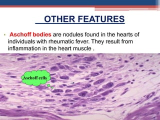 OTHER FEATURES
• Aschoff bodies are nodules found in the hearts of
individuals with rheumatic fever. They result from
inflammation in the heart muscle .
•
Aschoff cells
 