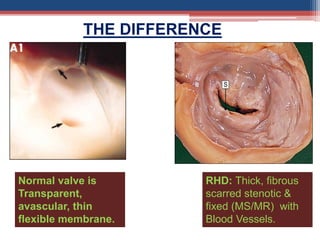Normal valve is
Transparent,
avascular, thin
flexible membrane.
RHD: Thick, fibrous
scarred stenotic &
fixed (MS/MR) with
Blood Vessels.
THE DIFFERENCE
 