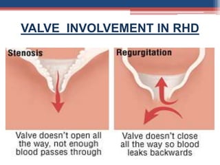 VALVE INVOLVEMENT IN RHD
 