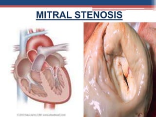 MITRAL STENOSIS
 