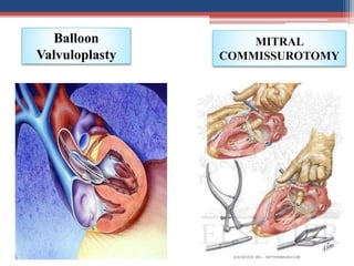 Balloon
Valvuloplasty
MITRAL
COMMISSUROTOMY
 