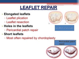 • Elongated leaflets
▫ Leaflet plication
▫ Leaflet resection
• Holes in the leaflets
▫ Pericardial patch repair
• Short leaflets
▫ Most often repaired by chordoplasty
 