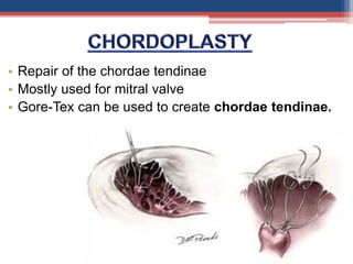 • Repair of the chordae tendinae
• Mostly used for mitral valve
• Gore-Tex can be used to create chordae tendinae.
 