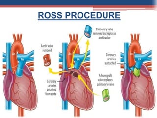 ROSS PROCEDURE
 