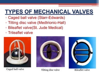 ▫ Caged ball valve (Starr-Edwards)
▫ Tilting disc valve (Medtrionic-Hall)
▫ Bileaflet valve(St. Jude Medical)
▫ Trileaflet valve
Caged ball valve Bileaflet valveTilting disc valve
 