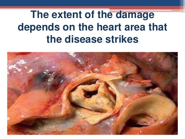 RHD – Rheumatic Heart Disease – DR. TRYNAADH