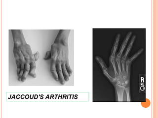 JACCOUD'S ARTHRITIS
 
