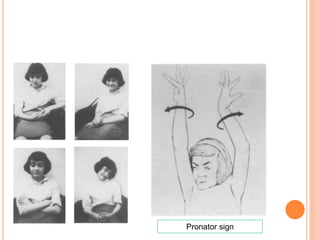 Pronator sign
 