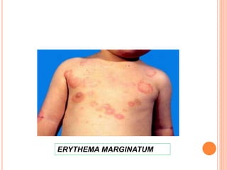ERYTHEMA MARGINATUM
 