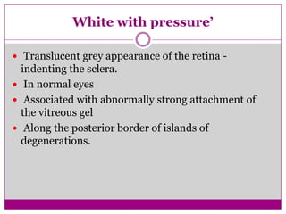White with pressure’
 Translucent grey appearance of the retina -

indenting the sclera.
 In normal eyes
 Associated with abnormally strong attachment of
the vitreous gel
 Along the posterior border of islands of
degenerations.

 