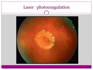 Laser photocoagulation

 
