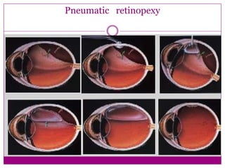 Pneumatic retinopexy

 