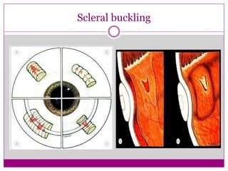 Scleral buckling

 
