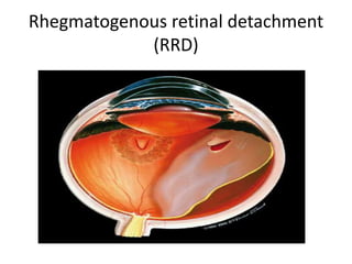 Rhegmatogenous retinal detachment (rrd) | PPTX