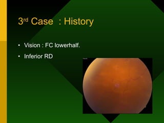 3 rd  Case  : History Vision : FC lowerhalf. Inferior RD  