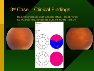 3 rd  Case  : Clinical Findings RE 6/18 cortical cat. BDR, Attached retina, Tear at 7 O’clk LE FC lower field, cortical cat. BDR, Inf. RD HST at 5.30 